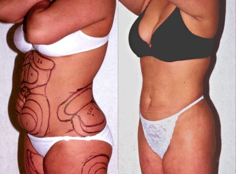 Liposuction Only before and after - before