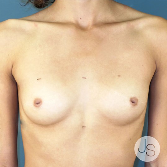 Breast Reconstruction before and after - before