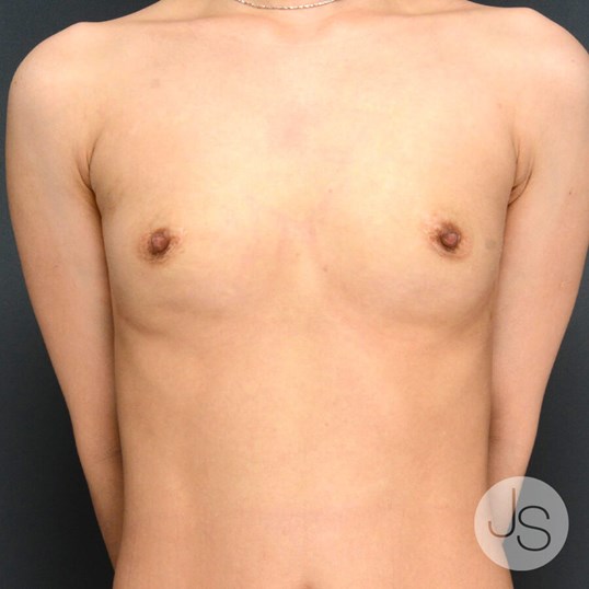 Breast Reconstruction before and after - before