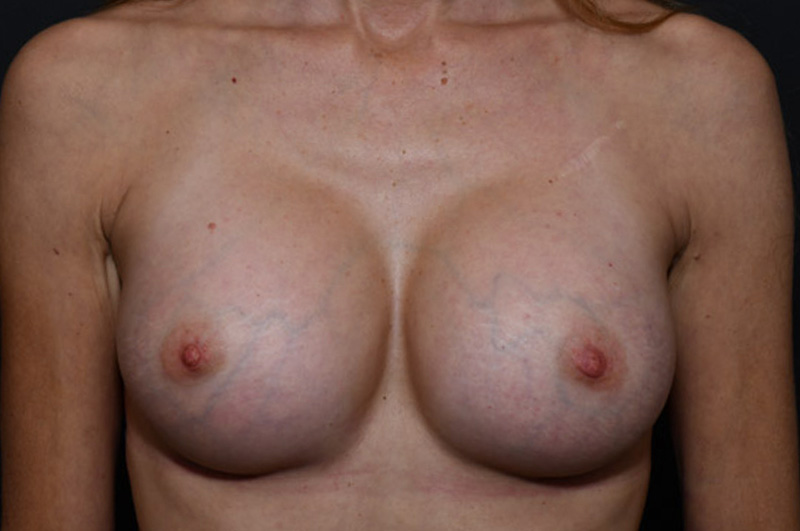 Breast Augmentation before and after - after
