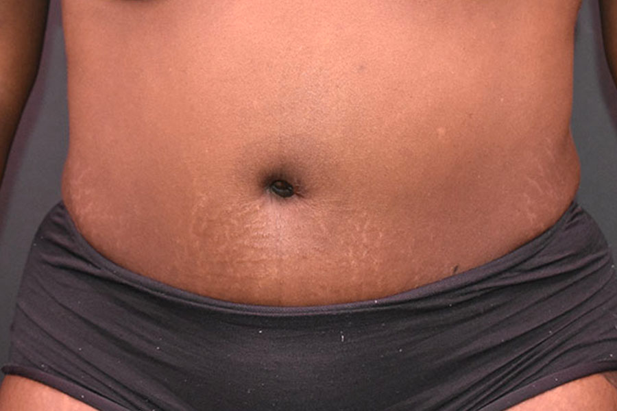 Tummy Tuck before and after - after