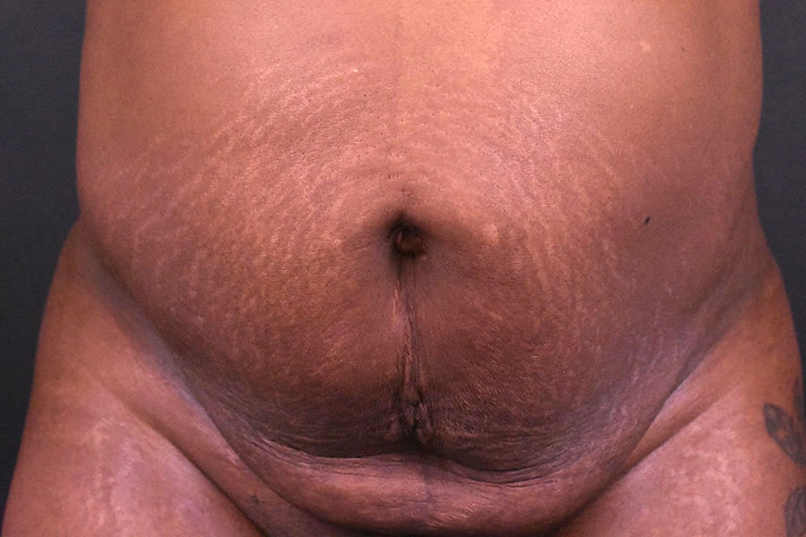 Tummy Tuck before and after - before