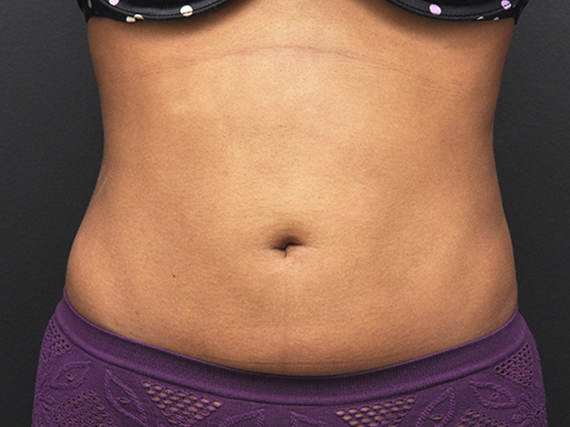 Liposuction before and after - after