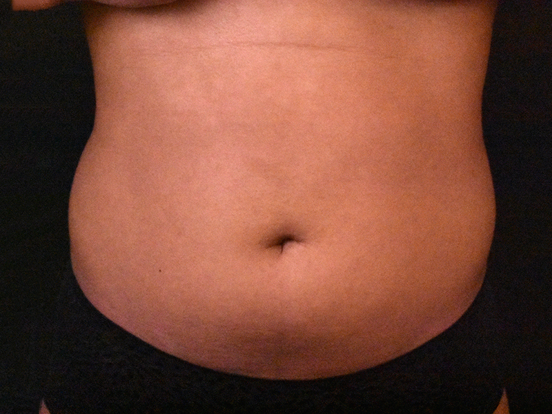 Liposuction before and after - before
