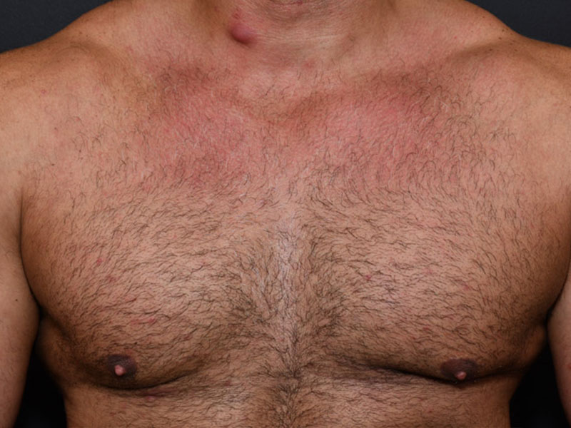 Liposuction before and after - after