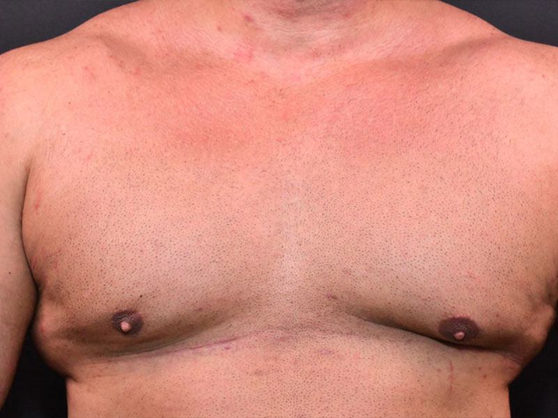 Liposuction before and after - before