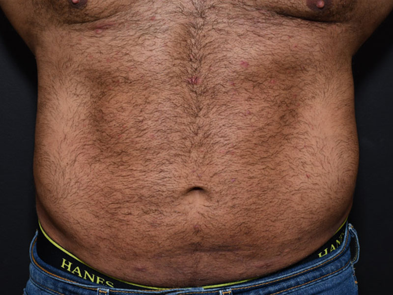 Liposuction before and after - after