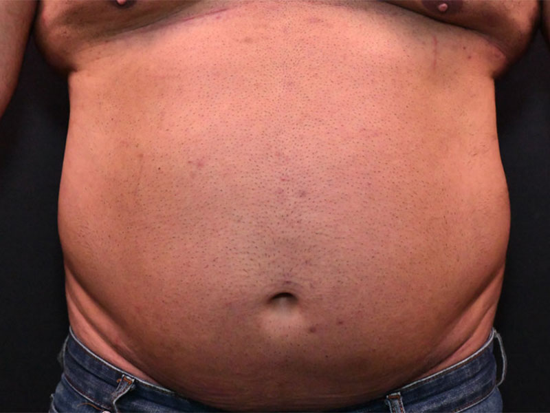 Liposuction before and after - before