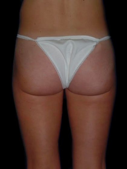 Body Contouring before and after - after