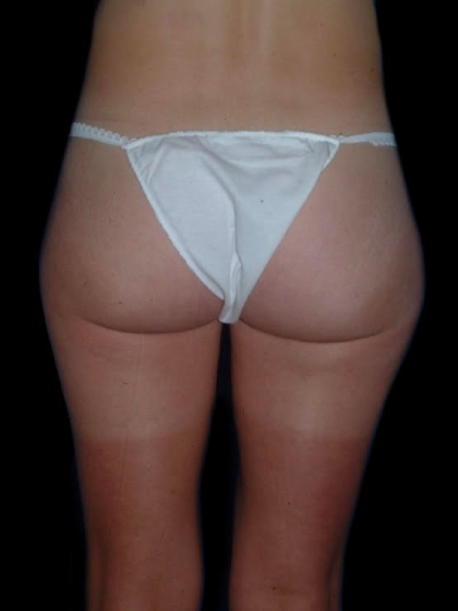 Body Contouring before and after - before