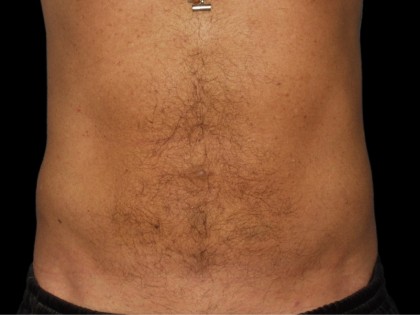 Procedure before and after - after