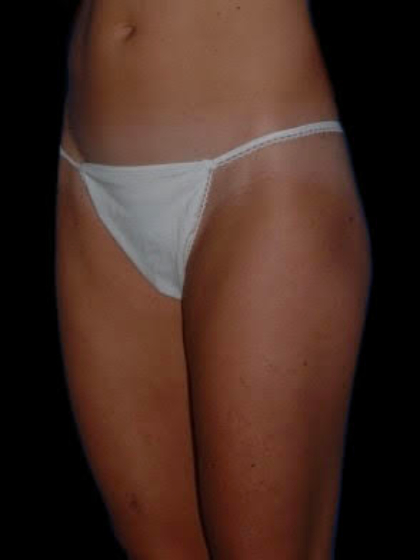 Body Contouring before and after - before
