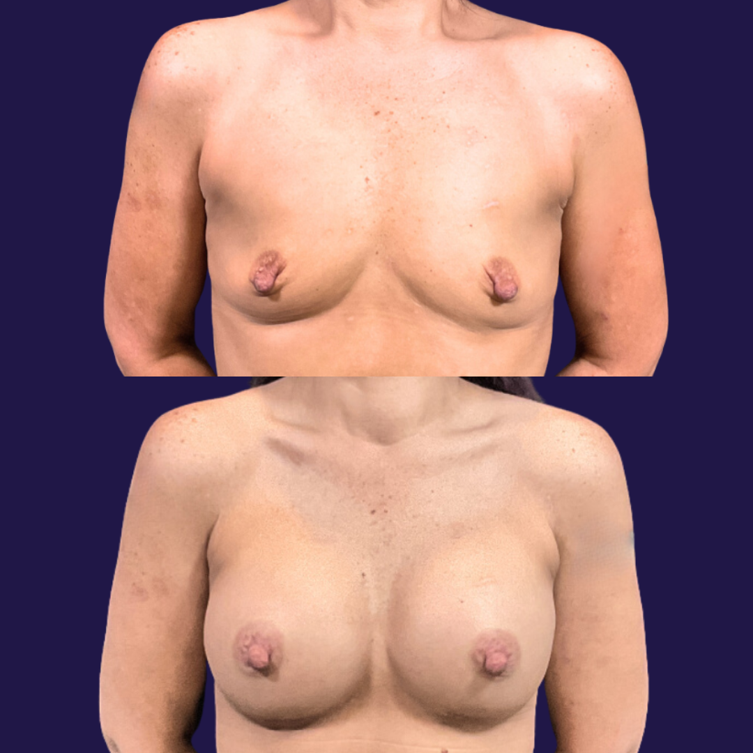 Breast Augmentation (Implants) before and after - after