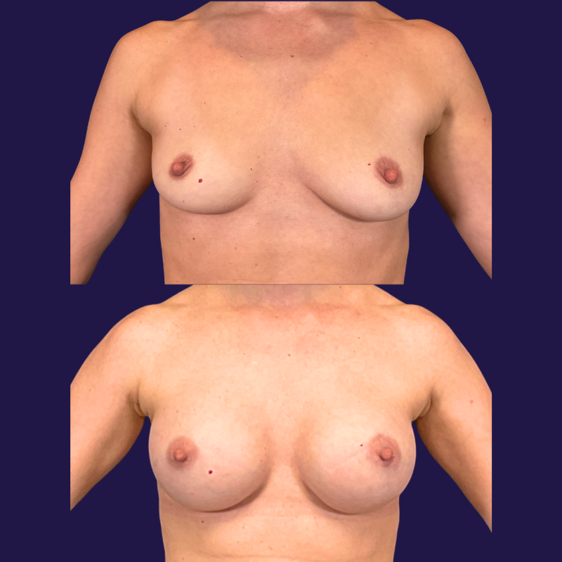 Breast Augmentation (Implants) before and after - before