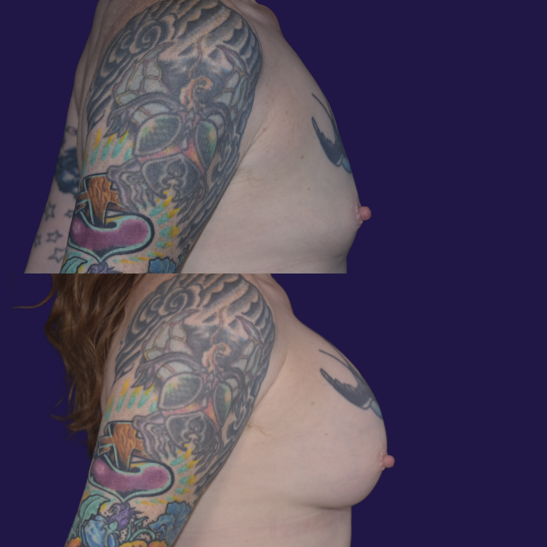 Breast Augmentation (Implants) before and after - after