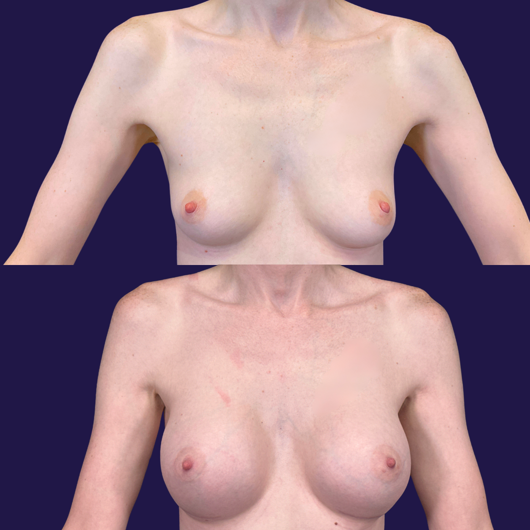 Breast Augmentation (Implants) before and after - before
