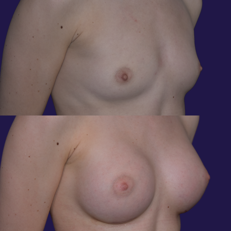 Breast Augmentation (Implants) before and after - after