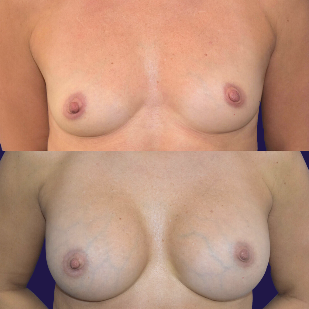 Breast Augmentation (Implants) before and after - before