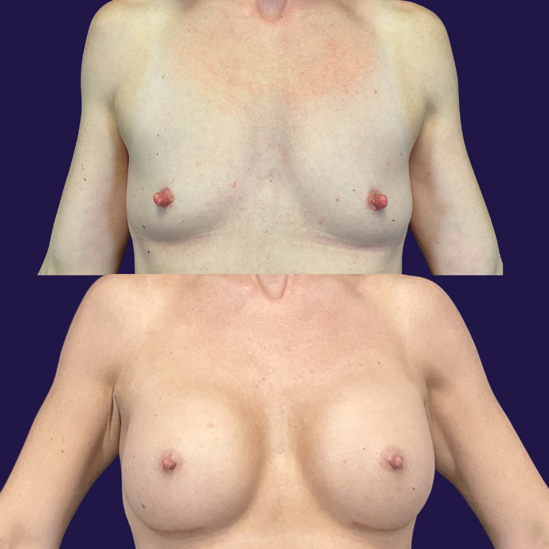 Breast Augmentation (Implants) before and after - after