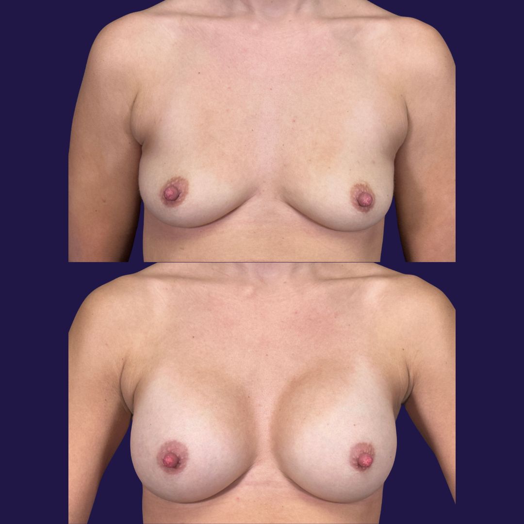 Breast Augmentation (Implants) before and after - before
