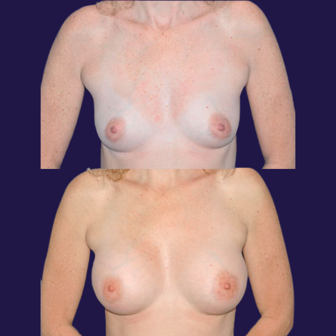 Breast Augmentation (Implants) before and after - before