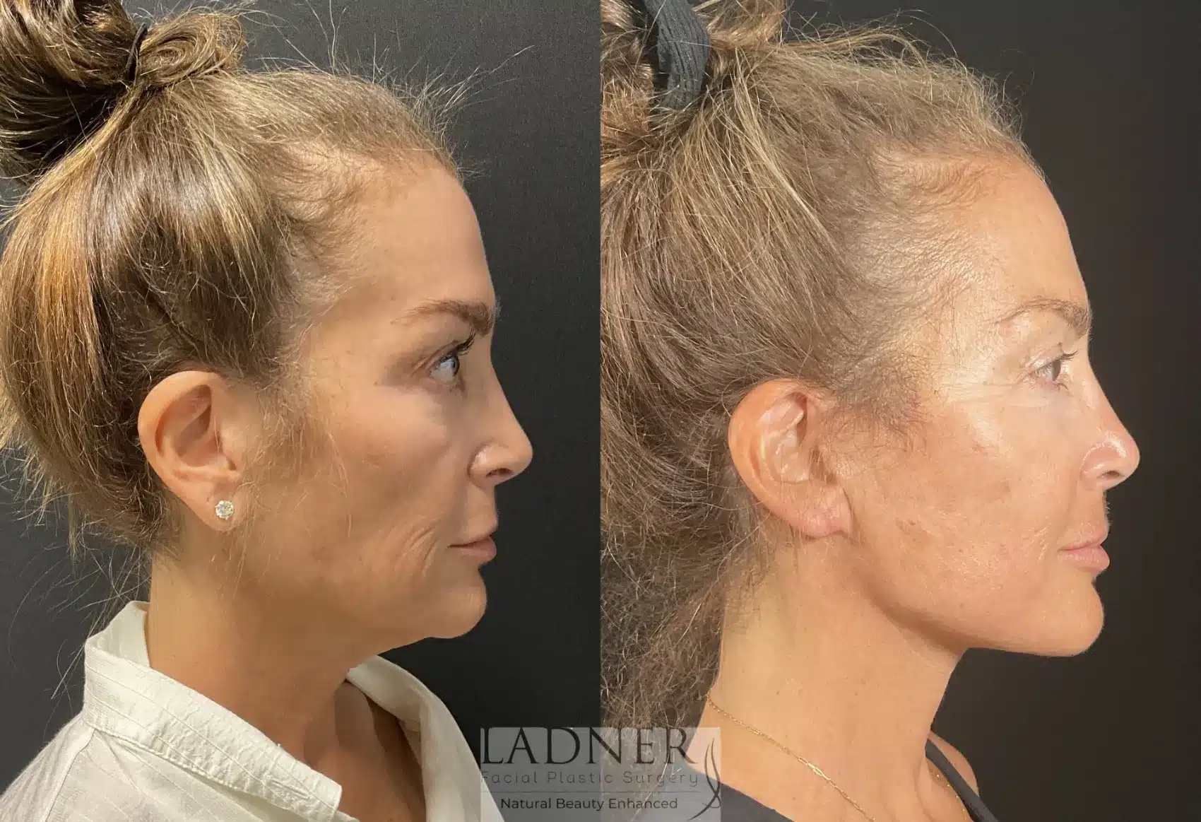 Ear Surgeries before and after - after