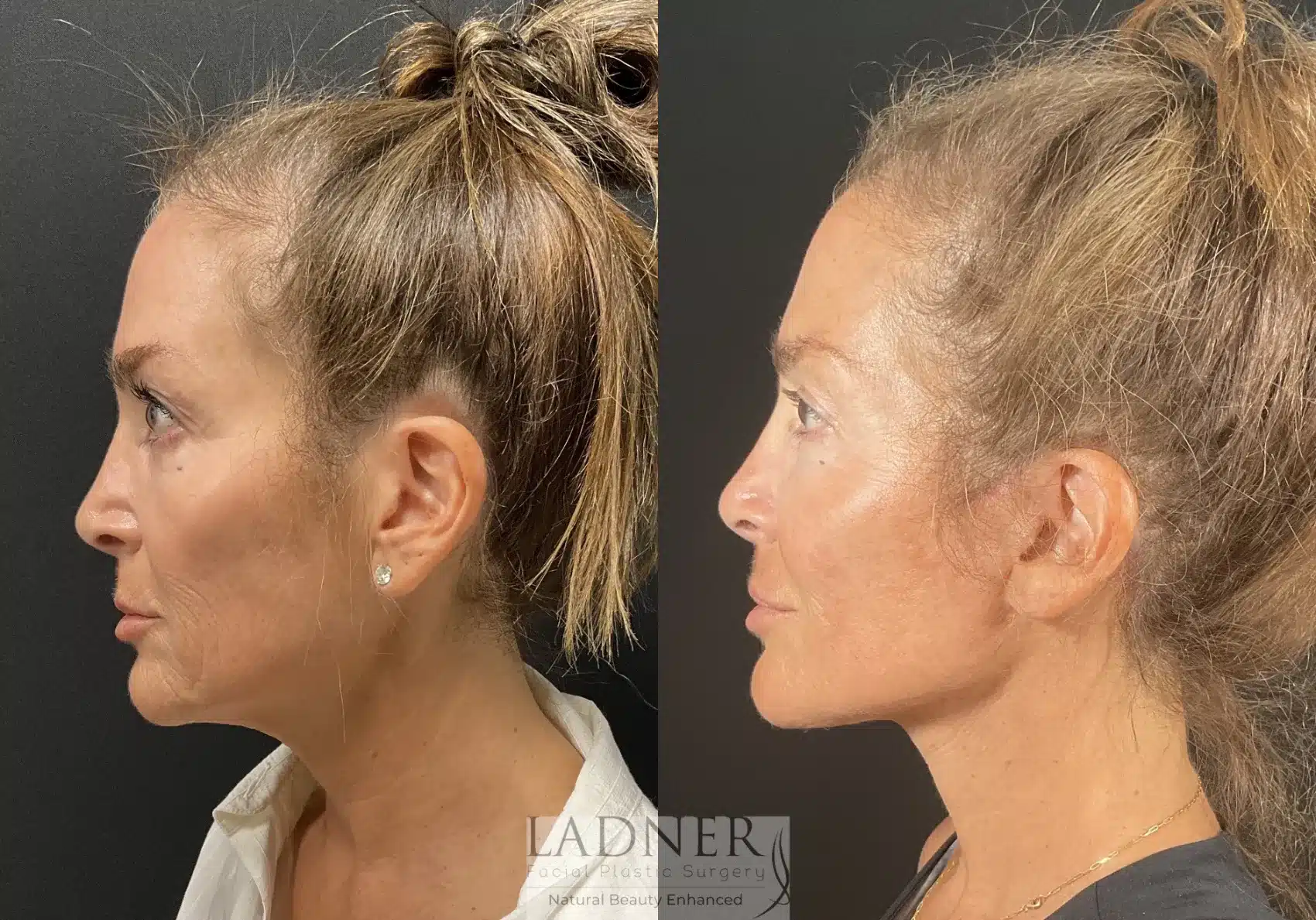 Ear Surgeries before and after - before