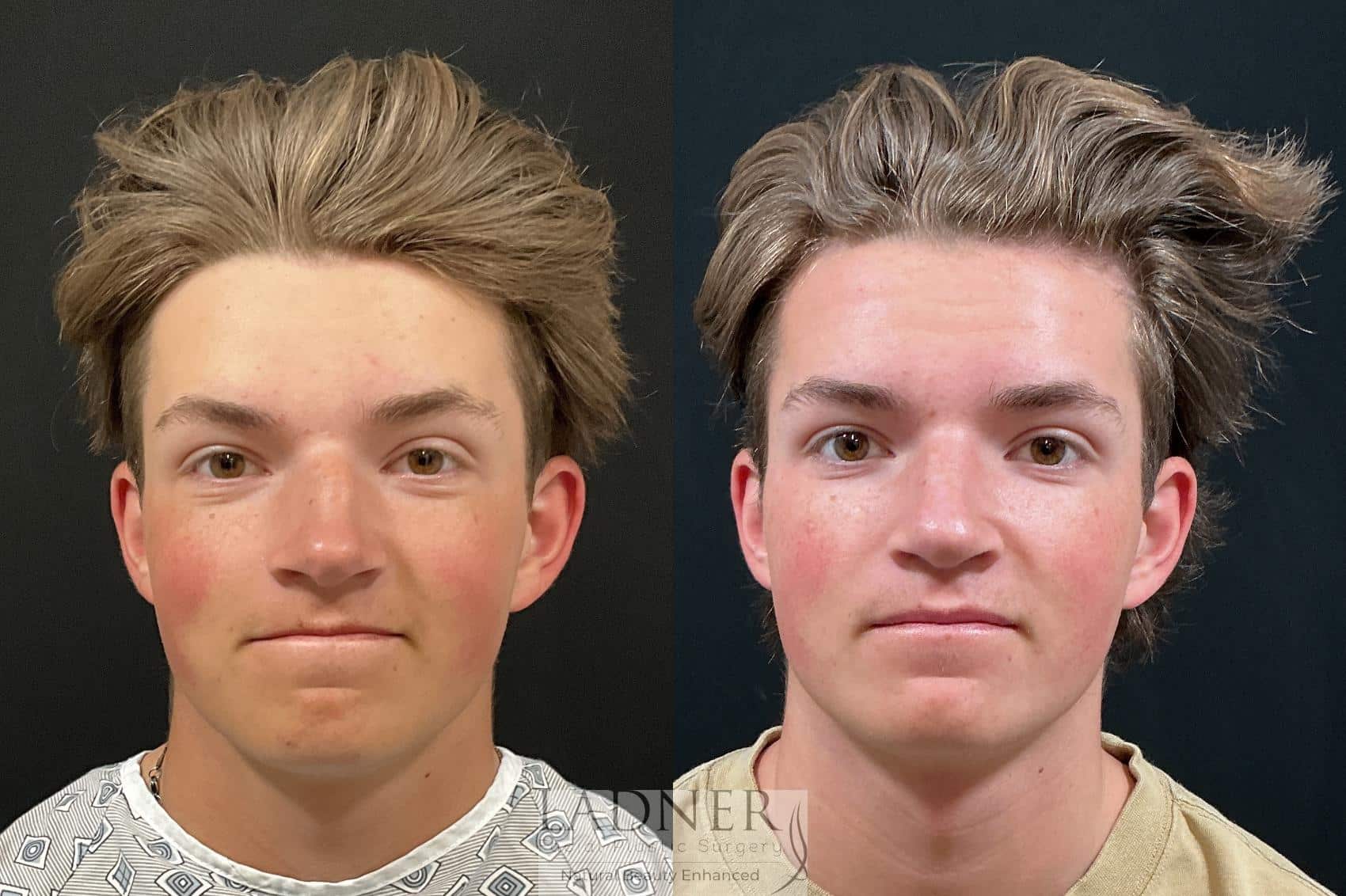 Open Rhinoplasty before and after - after