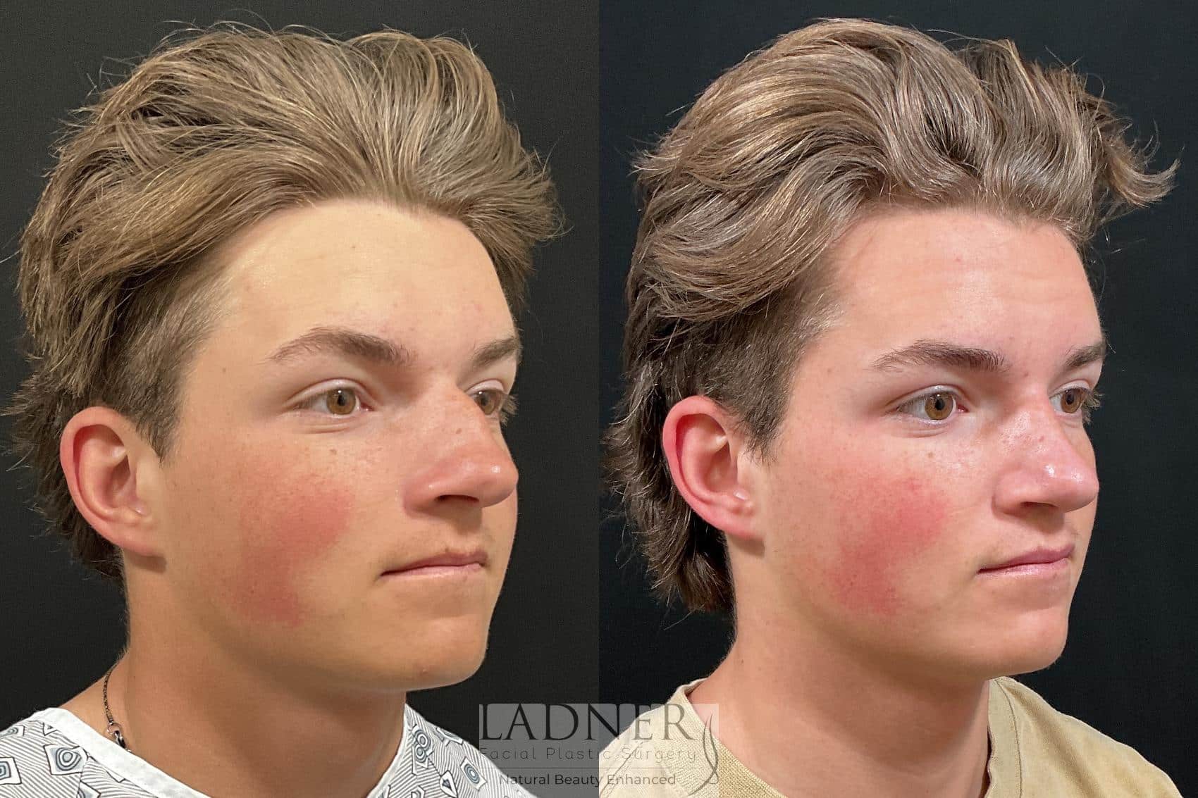Open Rhinoplasty before and after - before