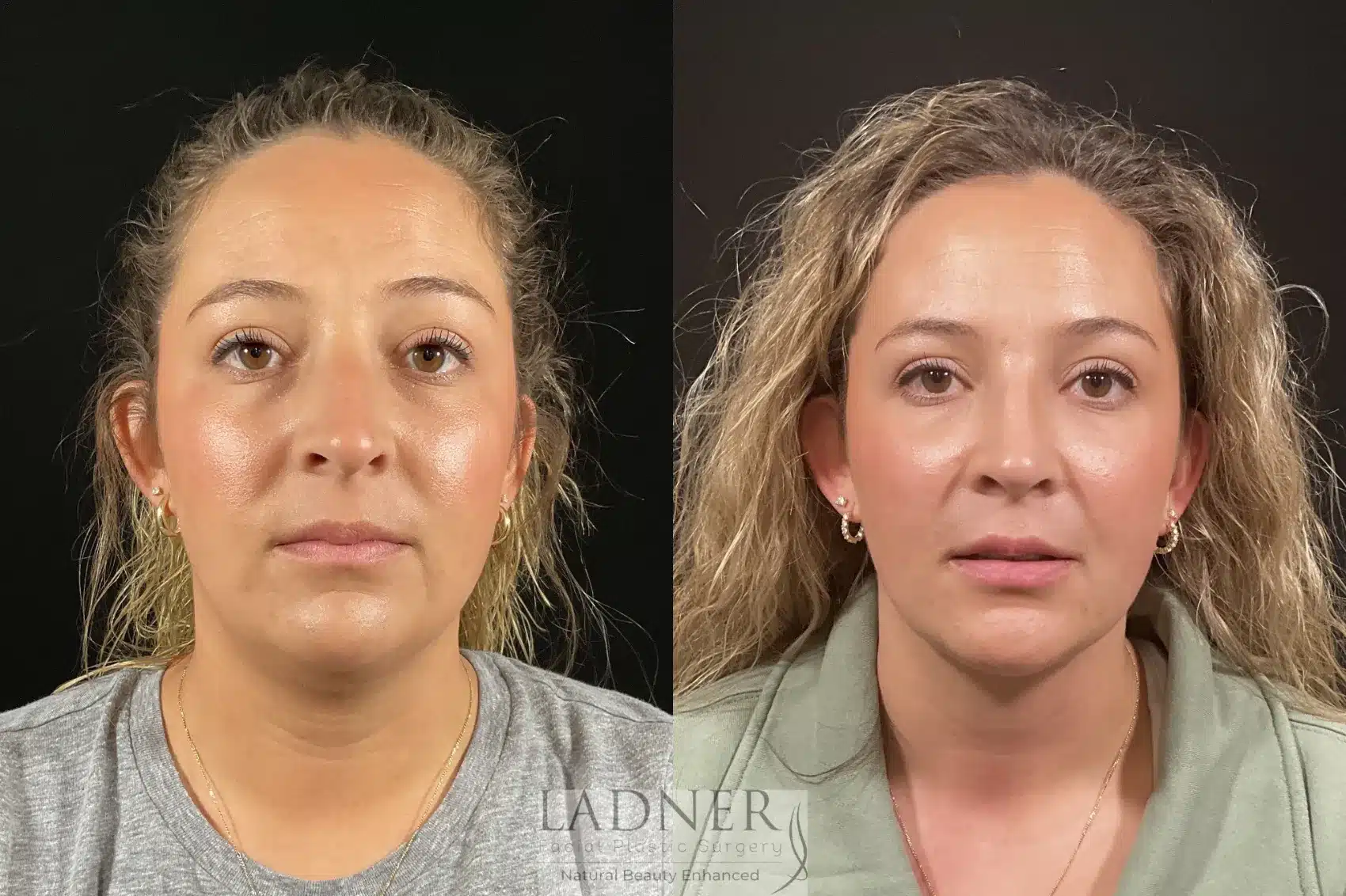 Minimally Invasive Neck Tightening & Rhinoplasty before and after - after