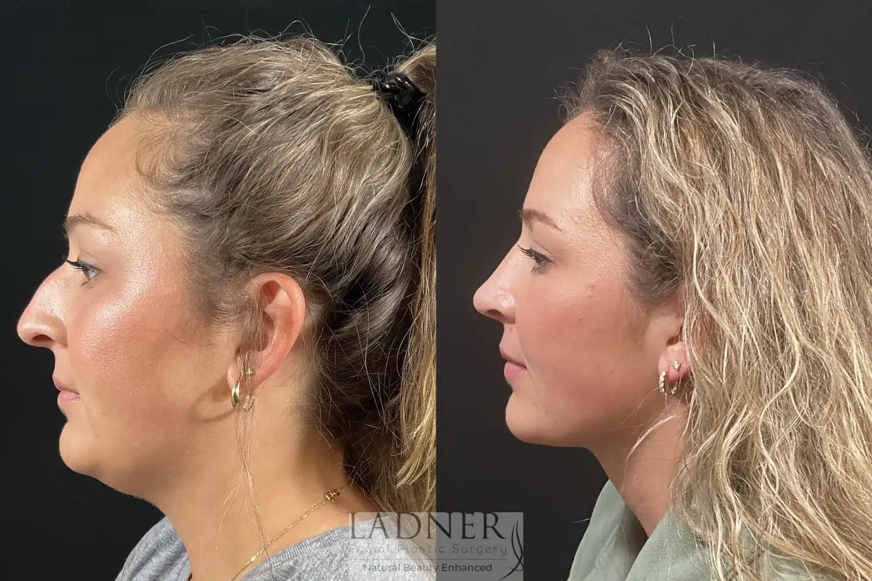 Minimally Invasive Neck Tightening & Rhinoplasty before and after - before
