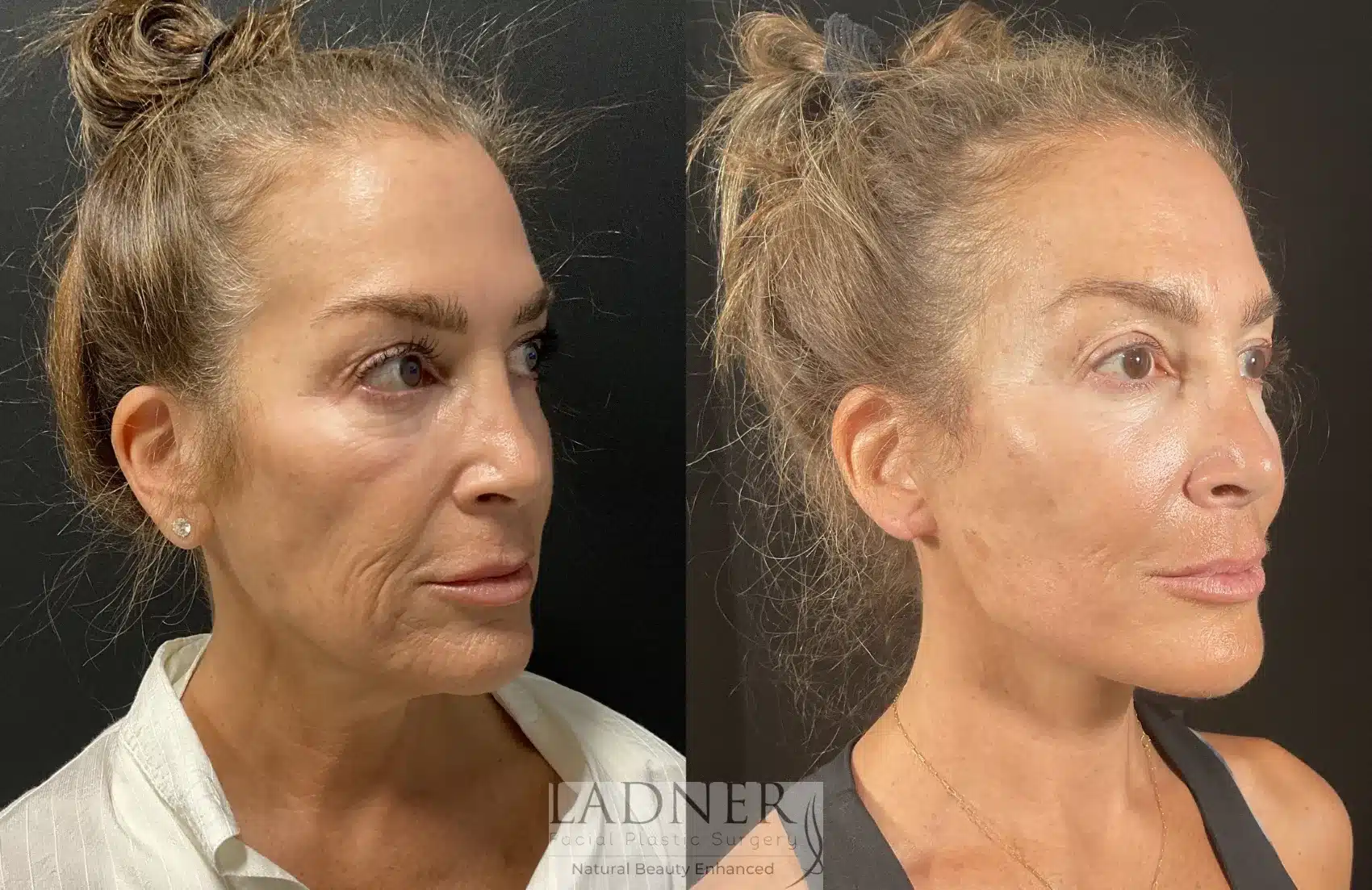 Ear Surgeries before and after - before