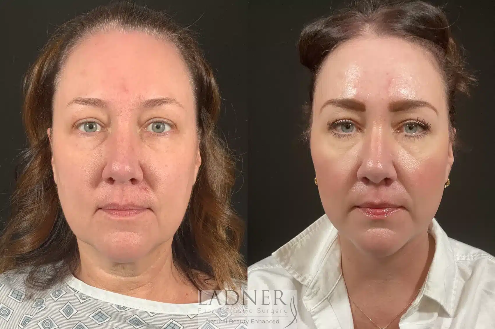 Lower Deep Plane Facelift & Submental Liposuction before and after - after