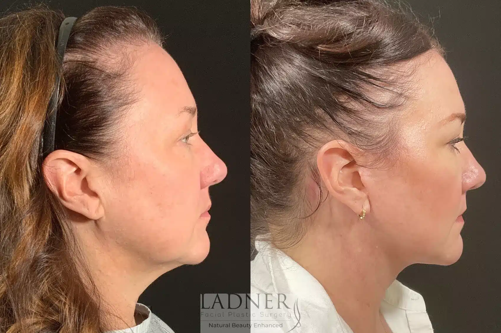 Lower Deep Plane Facelift & Submental Liposuction before and after - before
