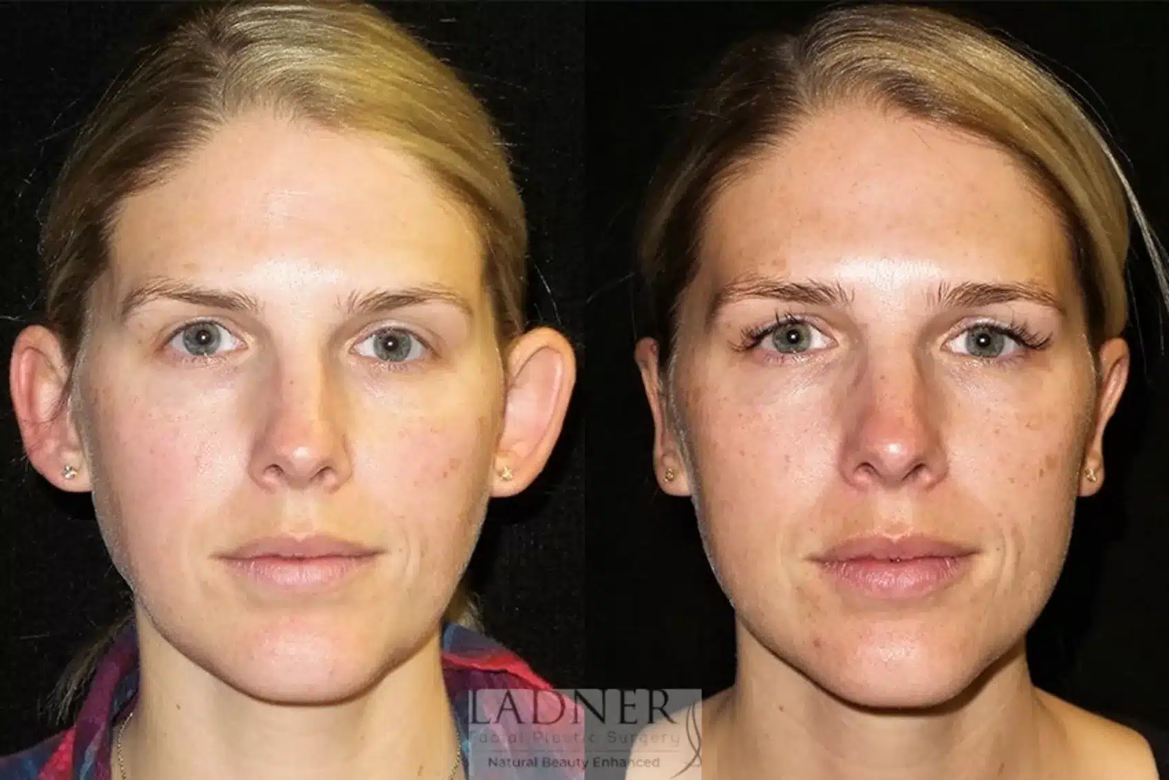 Ear Surgeries before and after - before