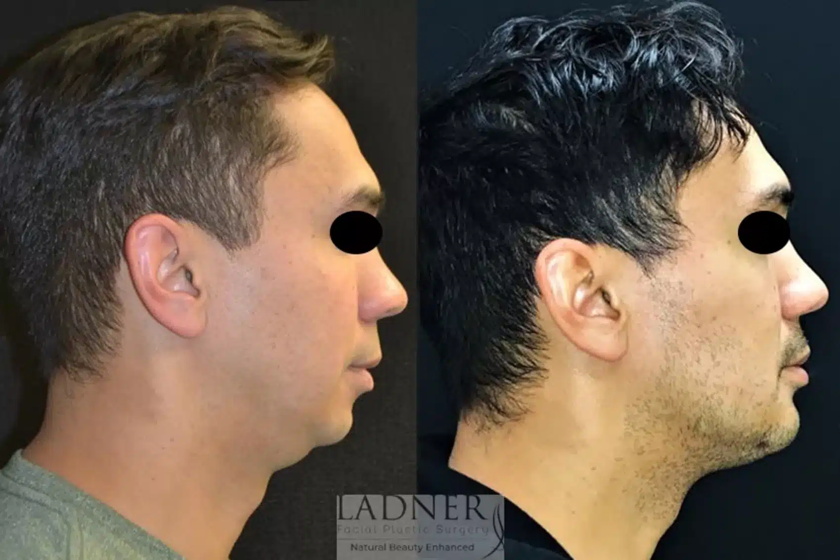 Chin Augmentation before and after - after