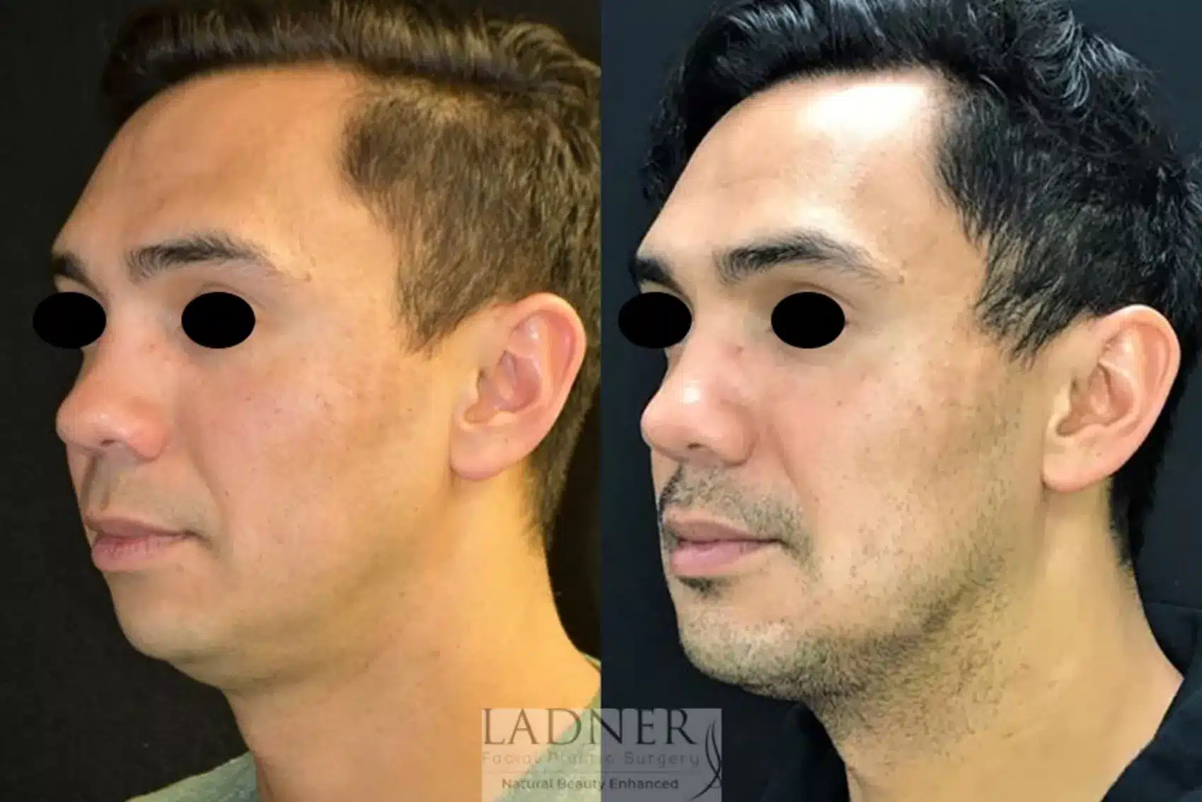 Chin Augmentation before and after - before