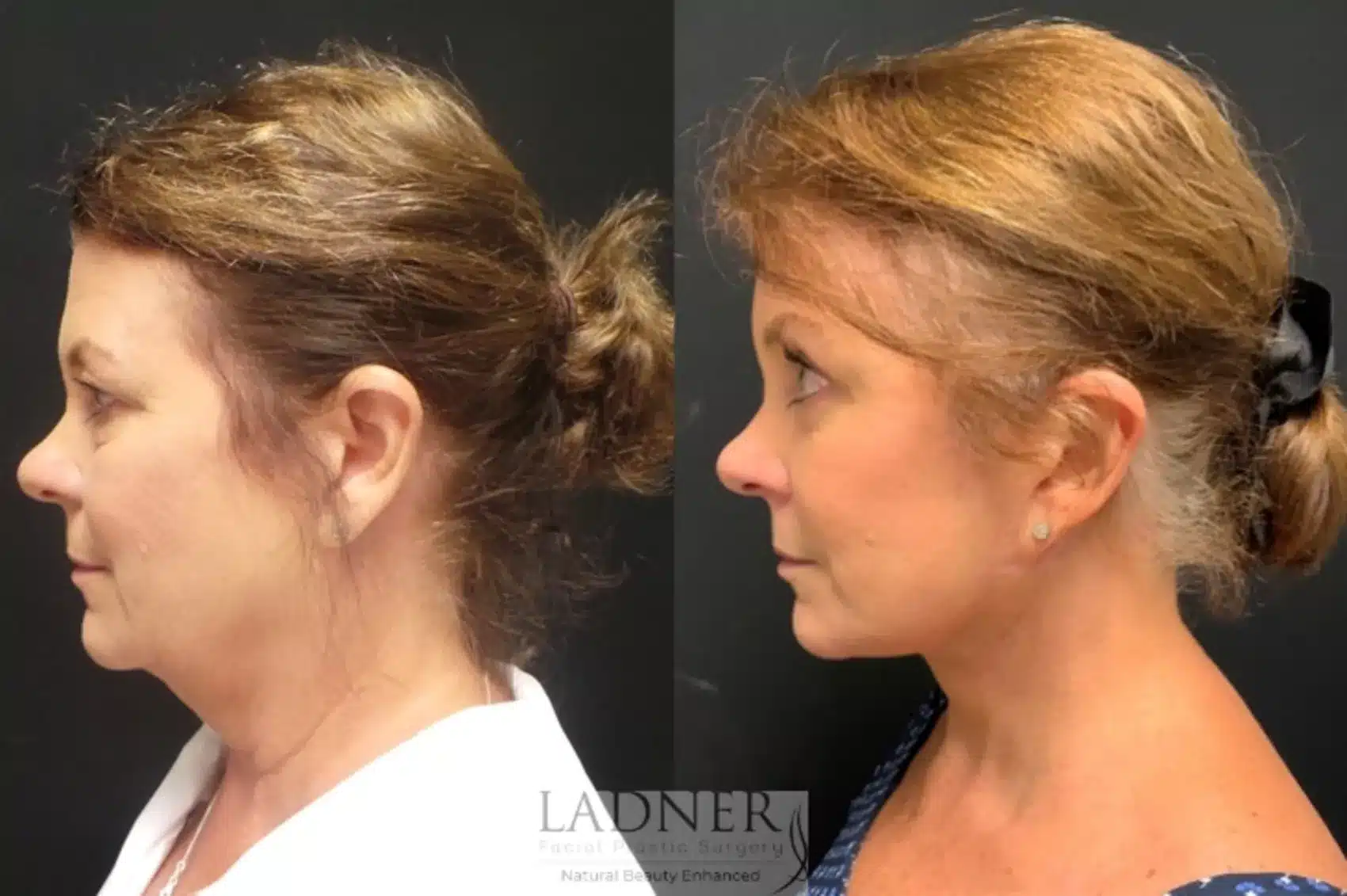 Deep Plane Facelift/Neck Lift, Blepharoplasty, and Brow Lift/Forehead Lift before and after - after