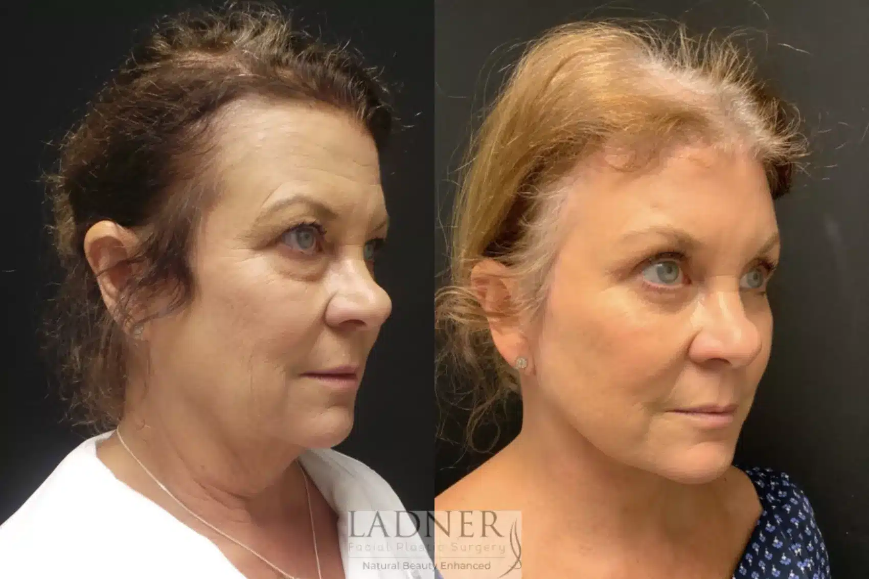 Deep Plane Facelift/Neck Lift, Blepharoplasty, and Brow Lift/Forehead Lift before and after - before