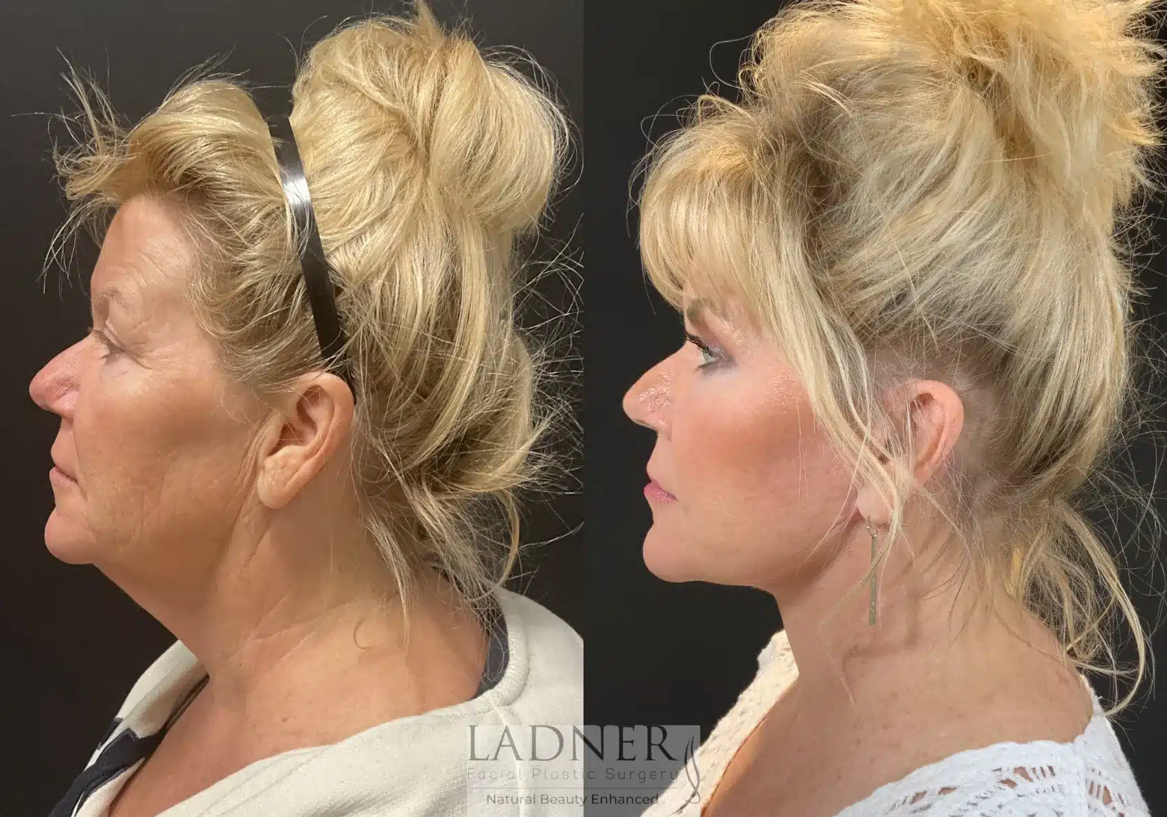 Lower Deep Plane Facelift & Blepharoplasty before and after - after
