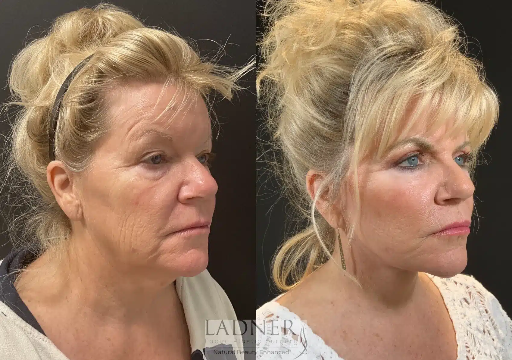 Lower Deep Plane Facelift & Blepharoplasty before and after - before
