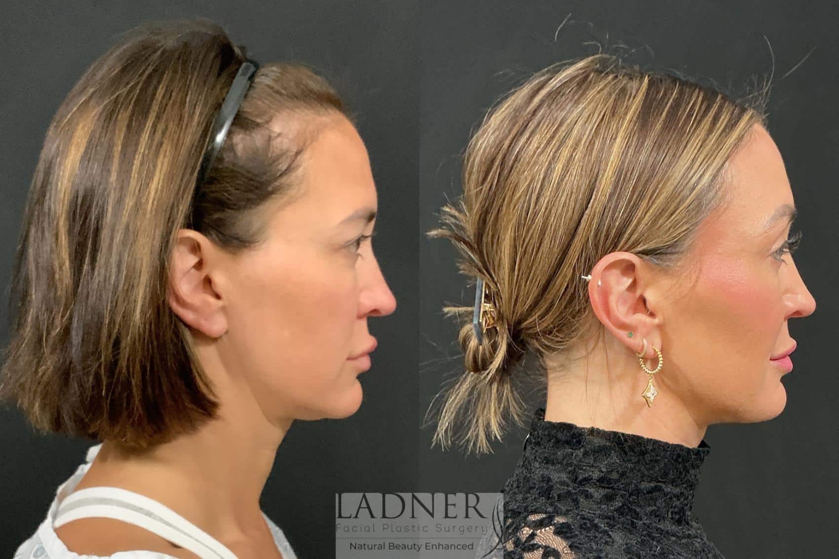 Brow Lift / Forehead Lift before and after - before