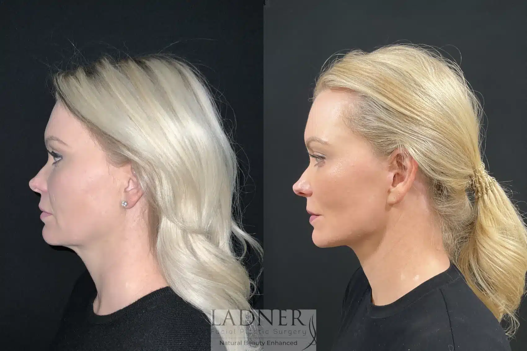 Deep Plane Necklift/Deep Plane Lower Facelift before and after - after