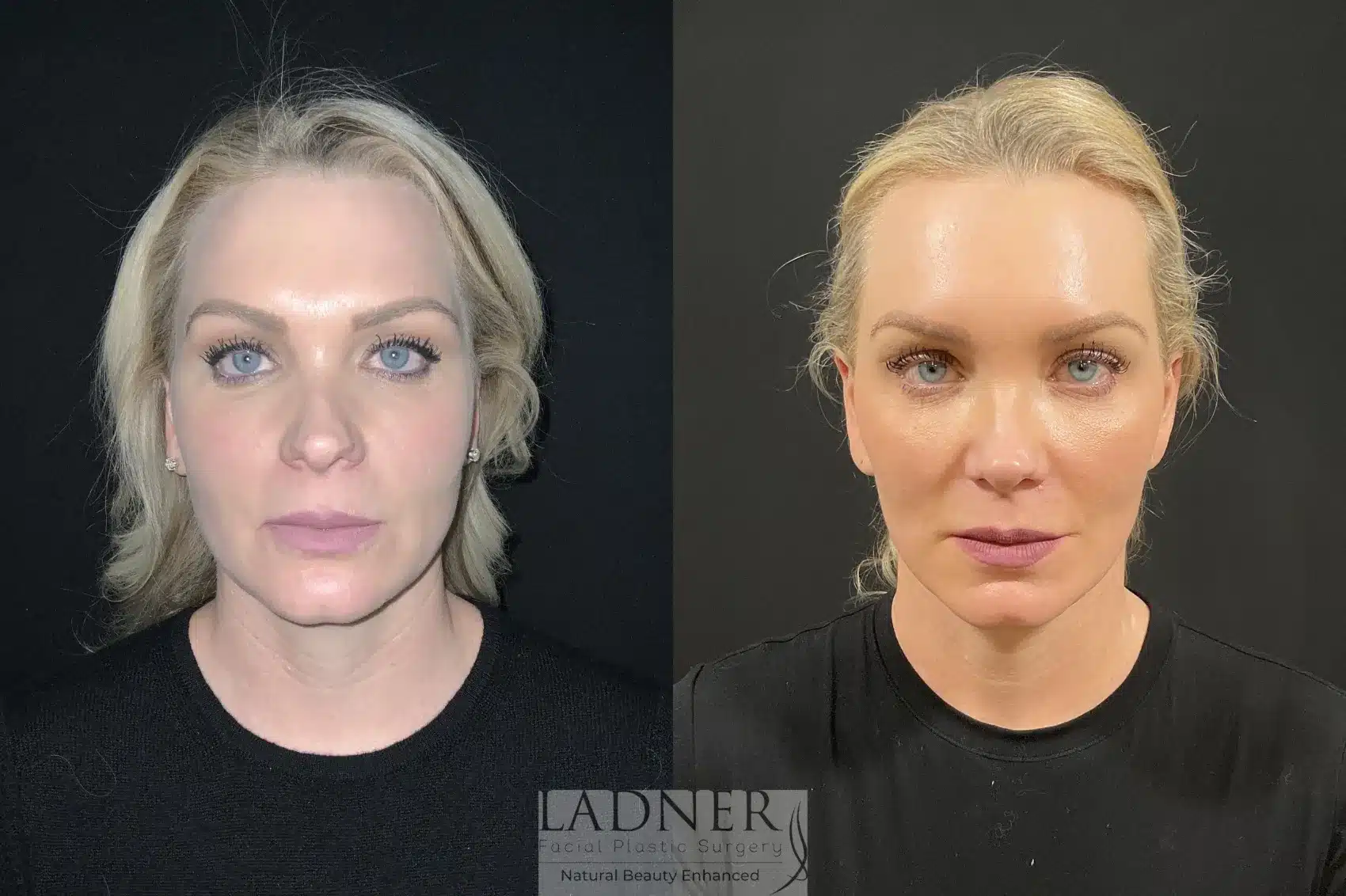 Deep Plane Necklift/Deep Plane Lower Facelift before and after - before