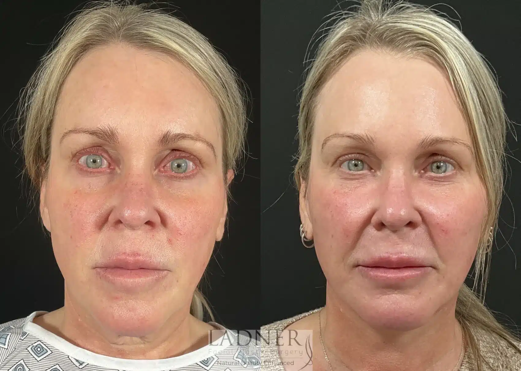Submental Liposuction before and after - after