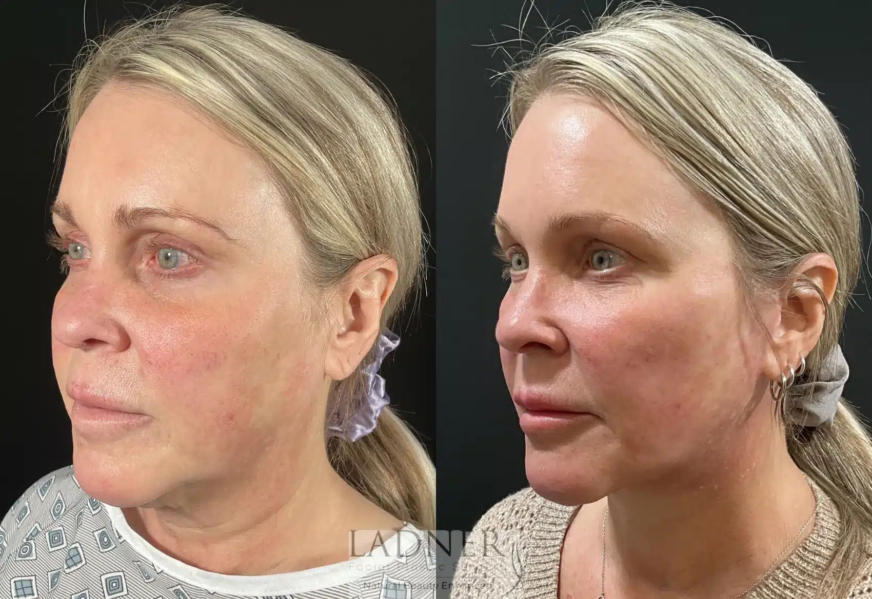 Submental Liposuction before and after - before