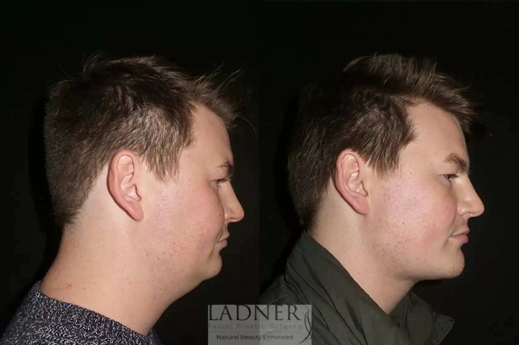 Chin Augmentation before and after - after