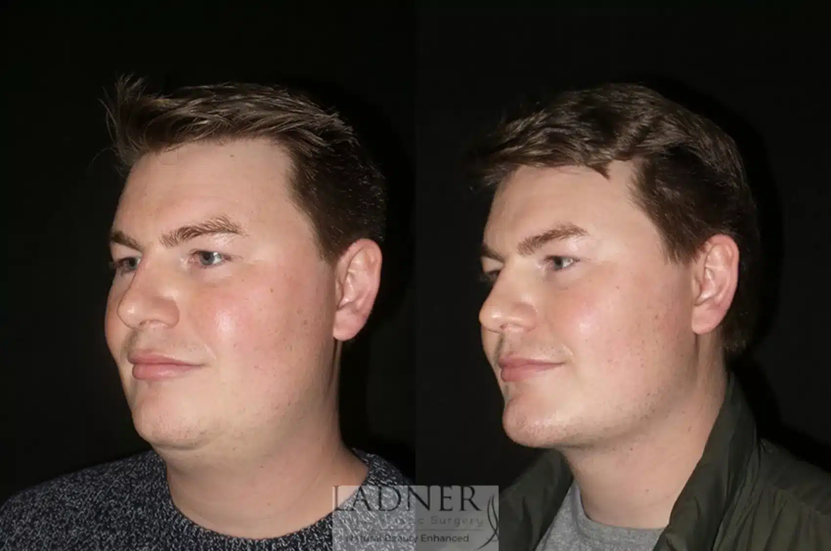 Chin Augmentation before and after - before