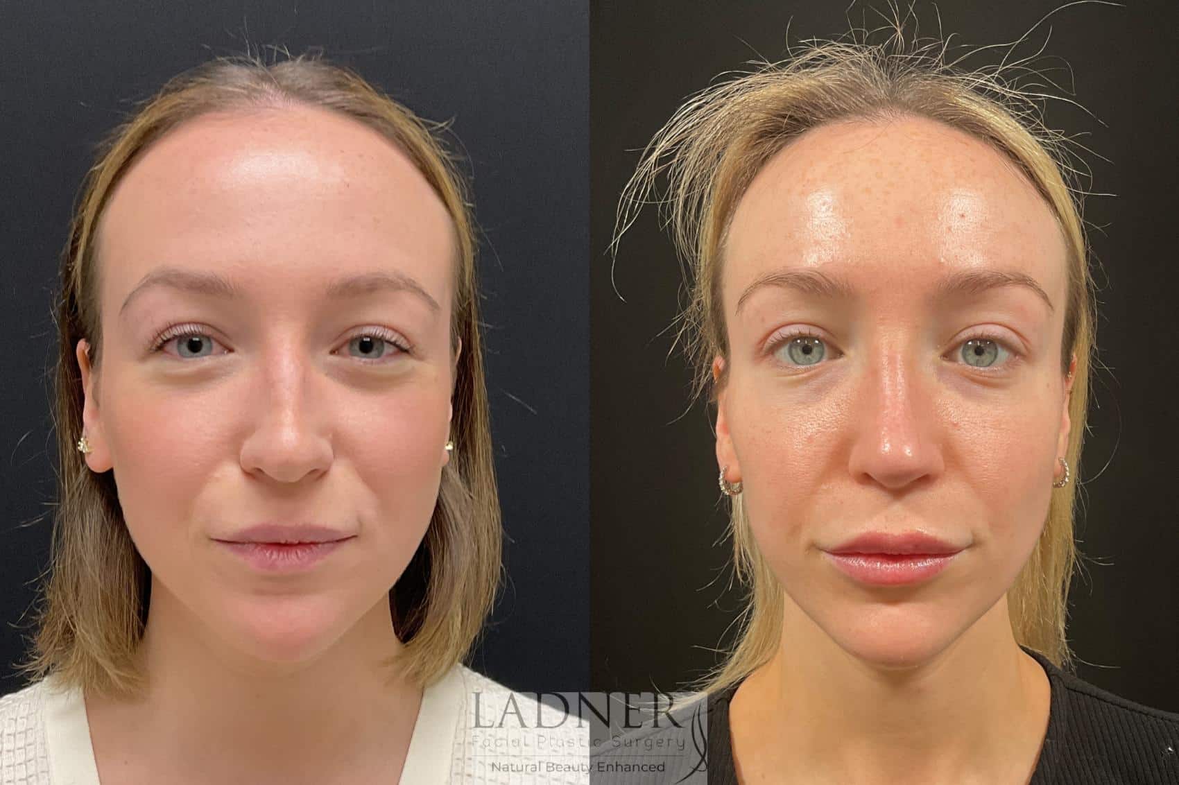 Rhinoplasty before and after - after
