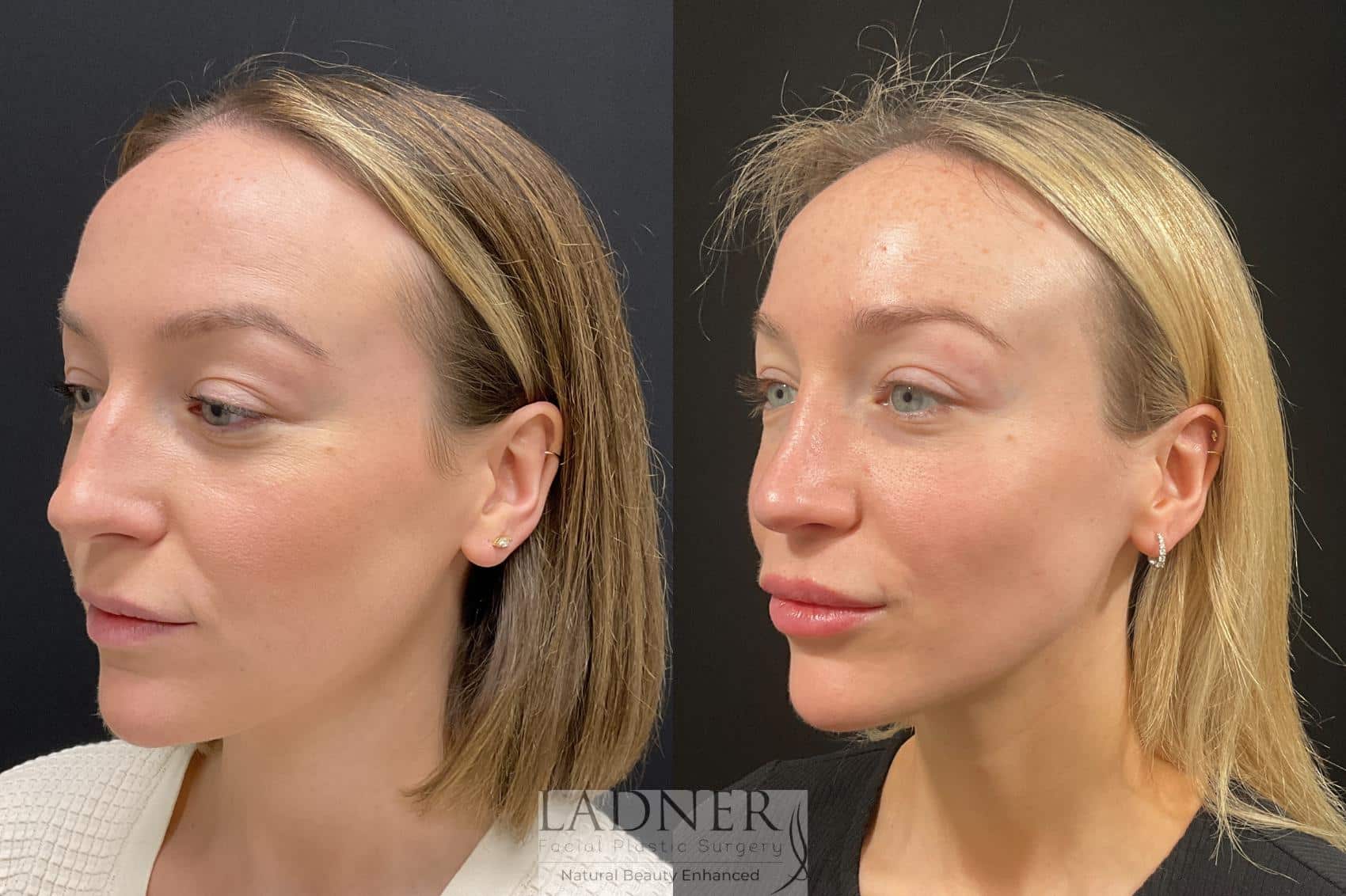 Rhinoplasty before and after - before